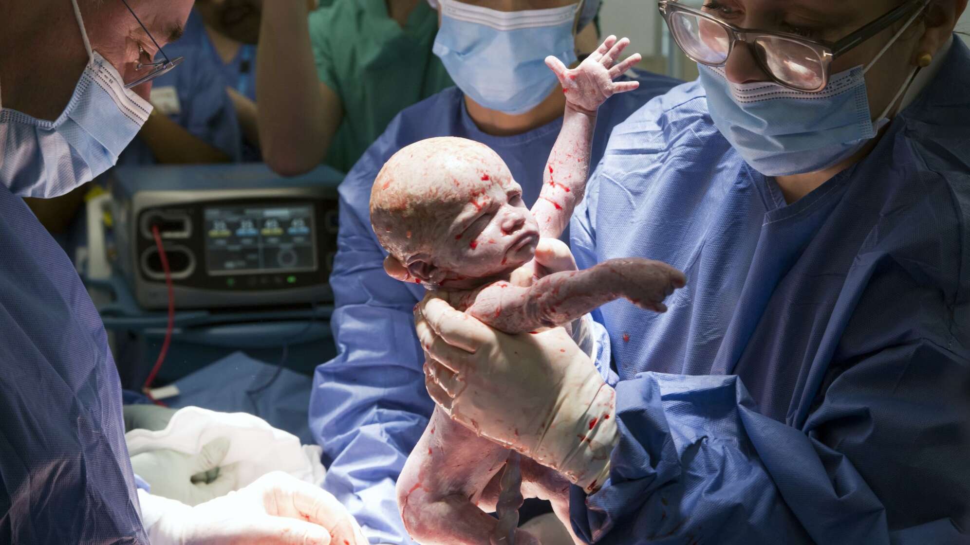 Die erste Gebärmuttertransplantation in Großbritannien